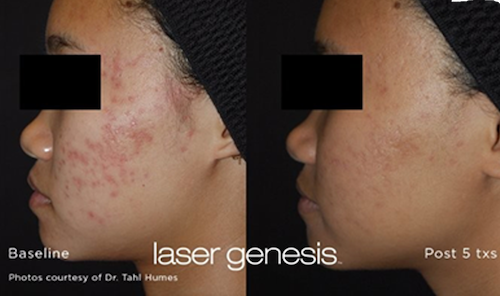 mississauga oakville hyperpigmentation skin treatment before after